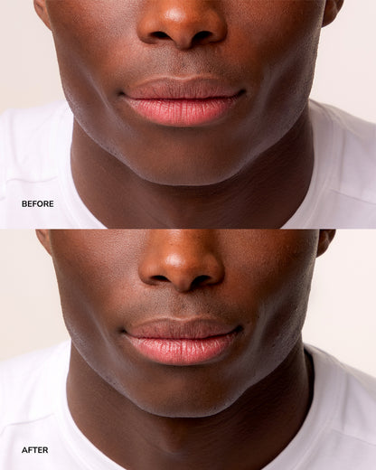 NORDH LIP TREATMENT